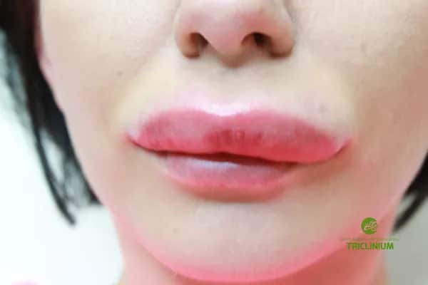Szybka ulga po powiększaniu ust: Ból i opuchlizna jak sobie radzić?