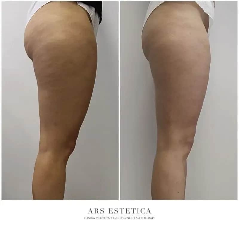 Skuteczny zabieg na cellulit? Poznaj typ i wybierz idealny!